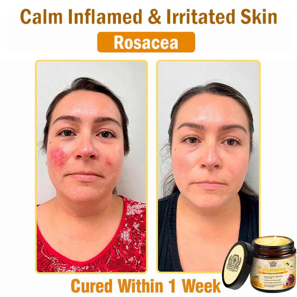 Bee Essence Skin Antibacterial Cream—used to treat a variety of skin diseases (AAD recommended)